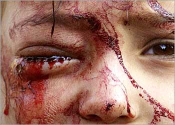 Iraq Images: Nothing but blood in the child's eyes socket