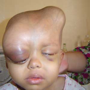 Another victim of Depleted Uranium